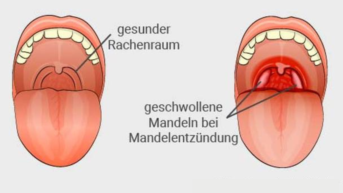 5 tage nach weisheitszahn-op noch schmerzen